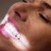 Professional Teeth Whitening in Minneapolis