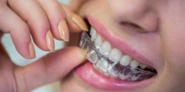 Essential Tips for Optimal Oral Health with ParisAline Clear Aligners