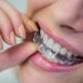 Essential Tips for Optimal Oral Health with ParisAline Clear Aligners
