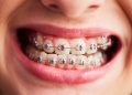 Discovering Invisalign Braces: The Clear Path to a Beautiful Smile in Greenville, NC