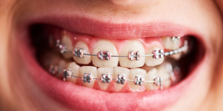 Discovering Invisalign Braces: The Clear Path to a Beautiful Smile in Greenville, NC