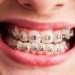 Discovering Invisalign Braces: The Clear Path to a Beautiful Smile in Greenville, NC
