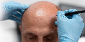 Why Los Angeles is the Perfect Place for Your Hair Transplant Journey
