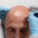 Why Los Angeles is the Perfect Place for Your Hair Transplant Journey